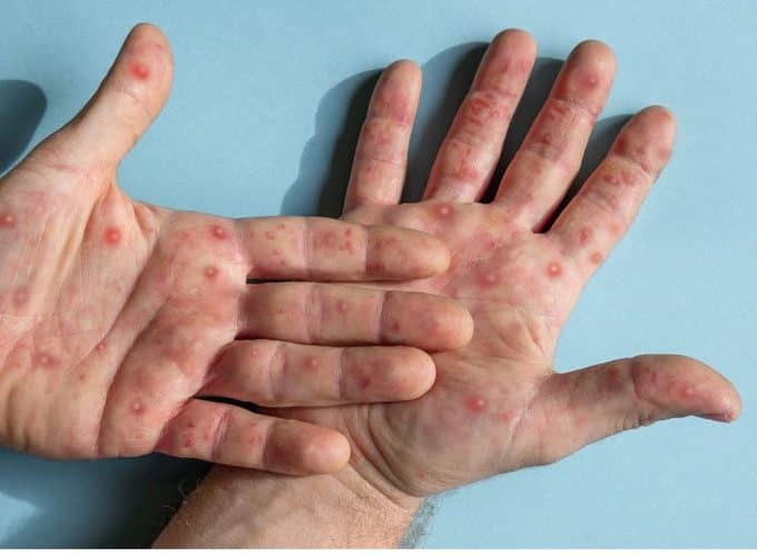 hands with mpox